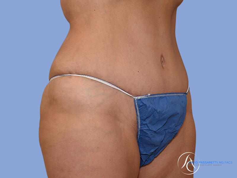 Abdominoplasty before & after photo