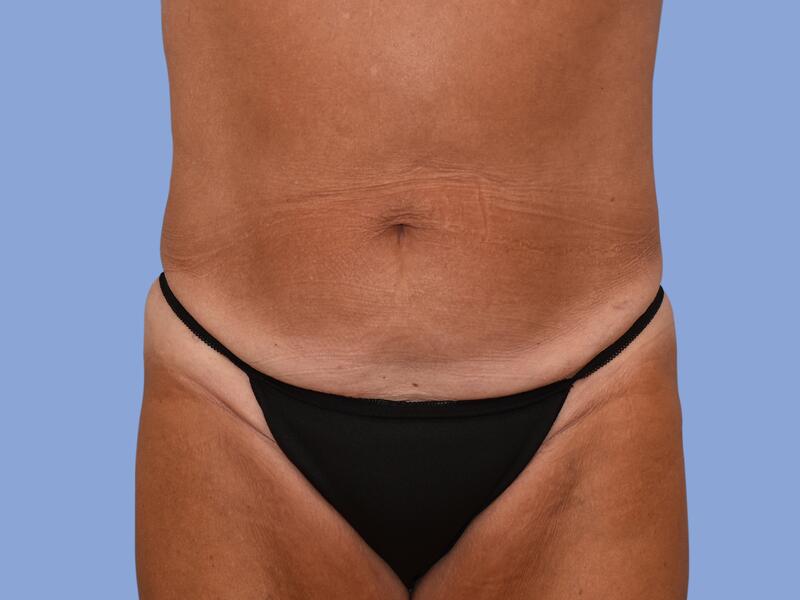 Abdominoplasty before & after photo