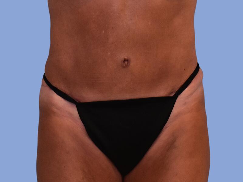 Abdominoplasty before & after photo