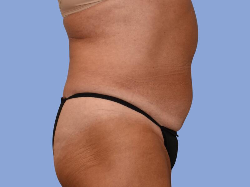 Abdominoplasty before & after photo