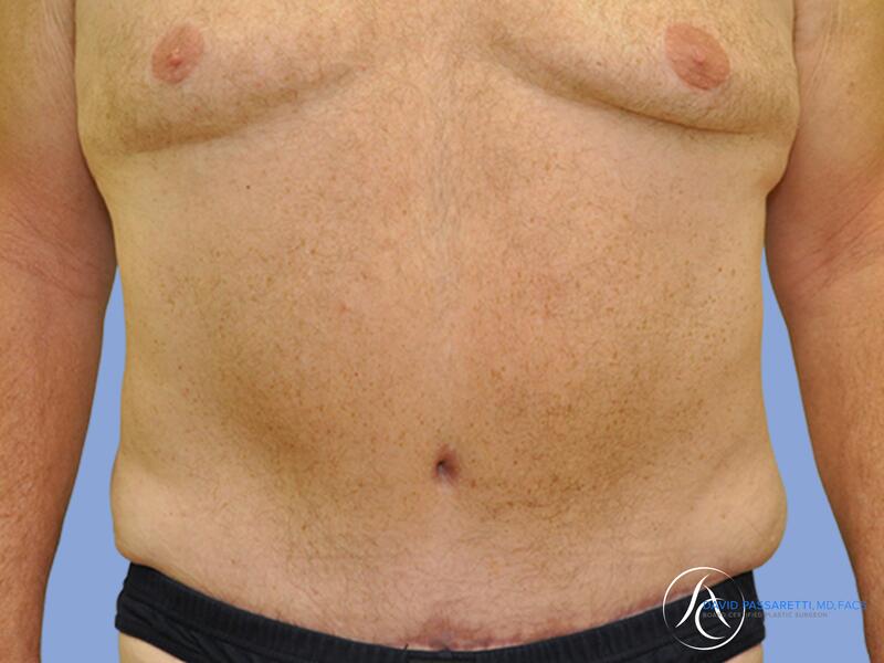 Abdominoplasty before & after photo