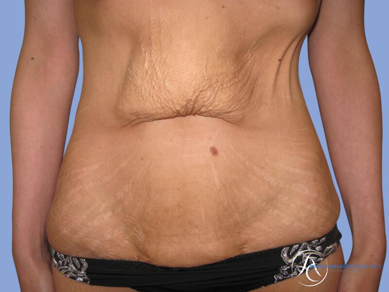 Abdominoplasty before & after photo