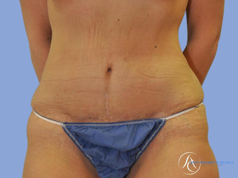 Abdominoplasty before & after photo