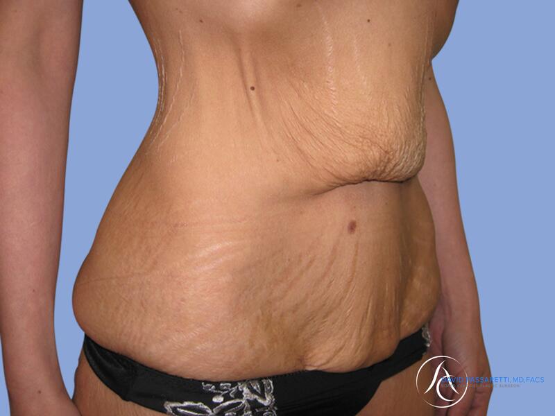 Abdominoplasty before & after photo