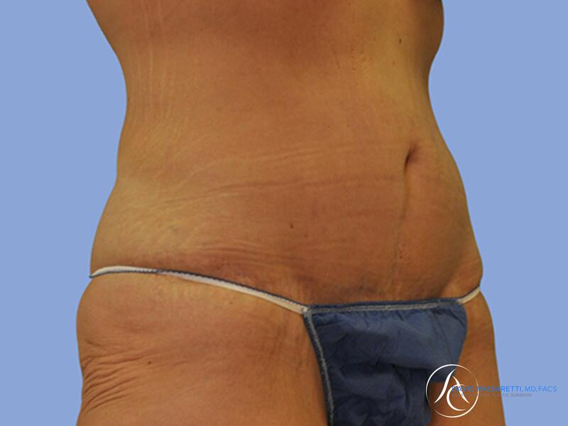 Abdominoplasty before & after photo