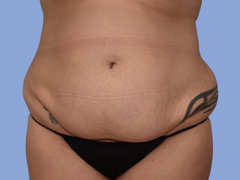 Abdominoplasty before & after photo