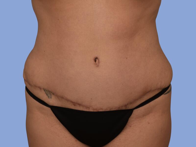 Abdominoplasty before & after photo