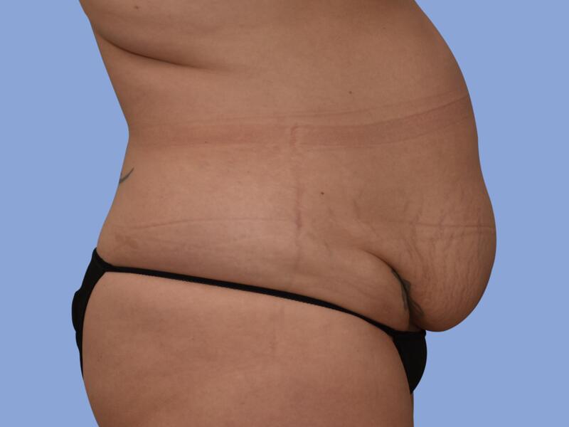 Abdominoplasty before & after photo