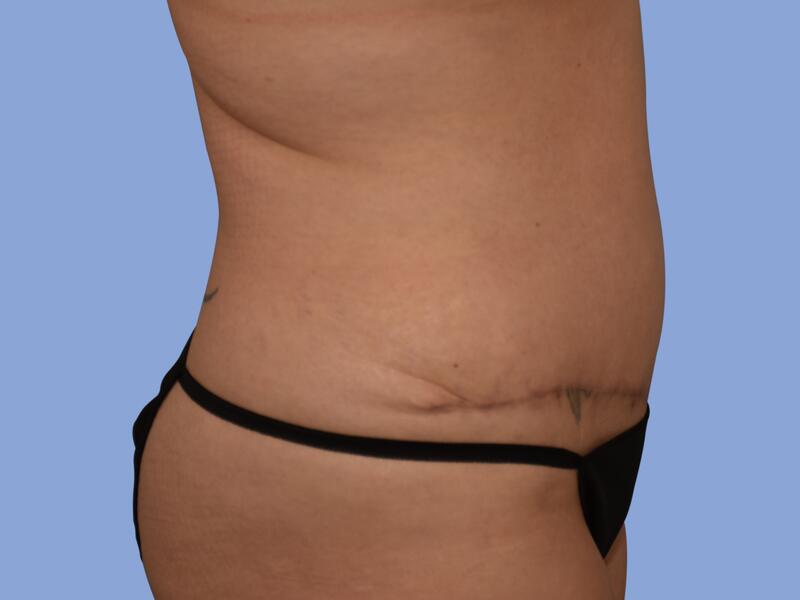 Abdominoplasty before & after photo