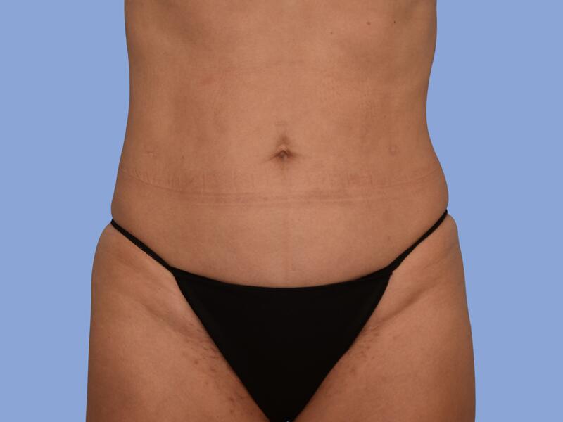 Abdominoplasty before & after photo