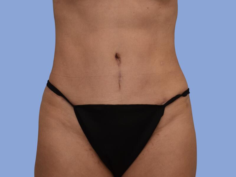 Abdominoplasty before & after photo