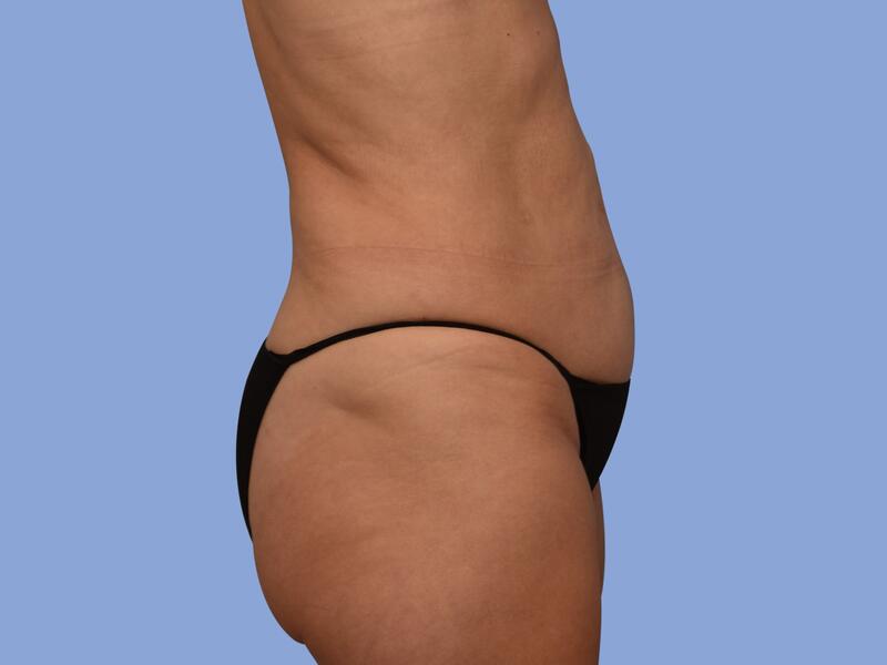 Abdominoplasty before & after photo