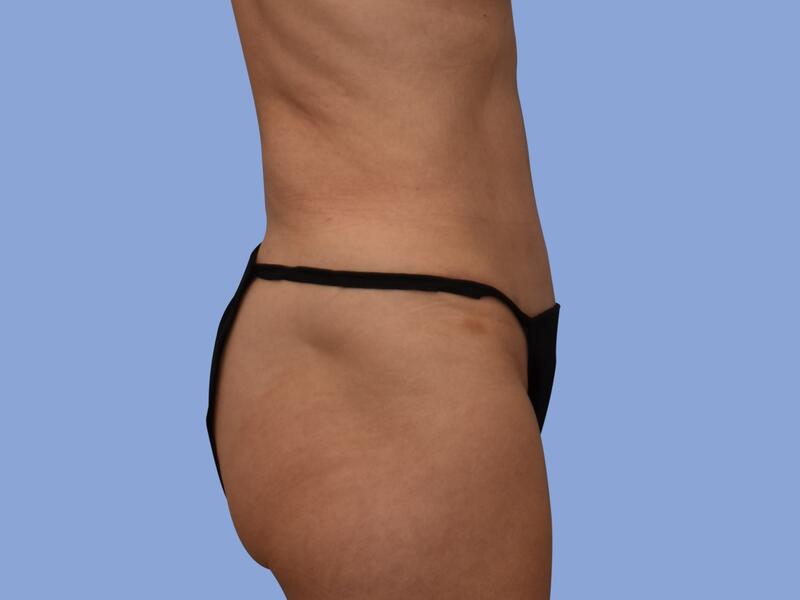 Abdominoplasty before & after photo