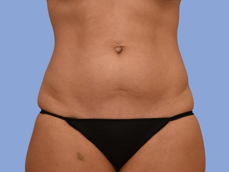 Abdominoplasty before & after photo