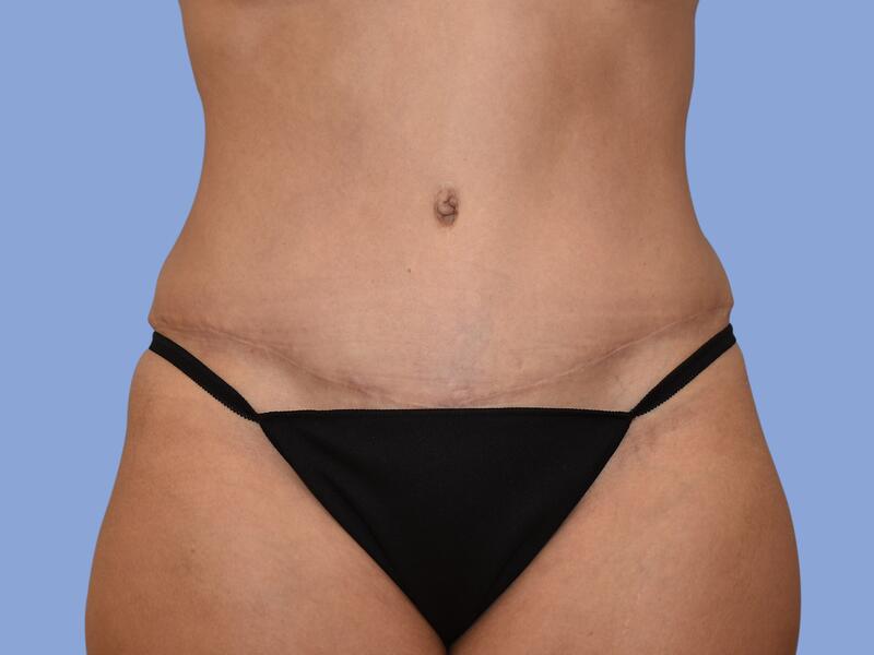 Abdominoplasty before & after photo