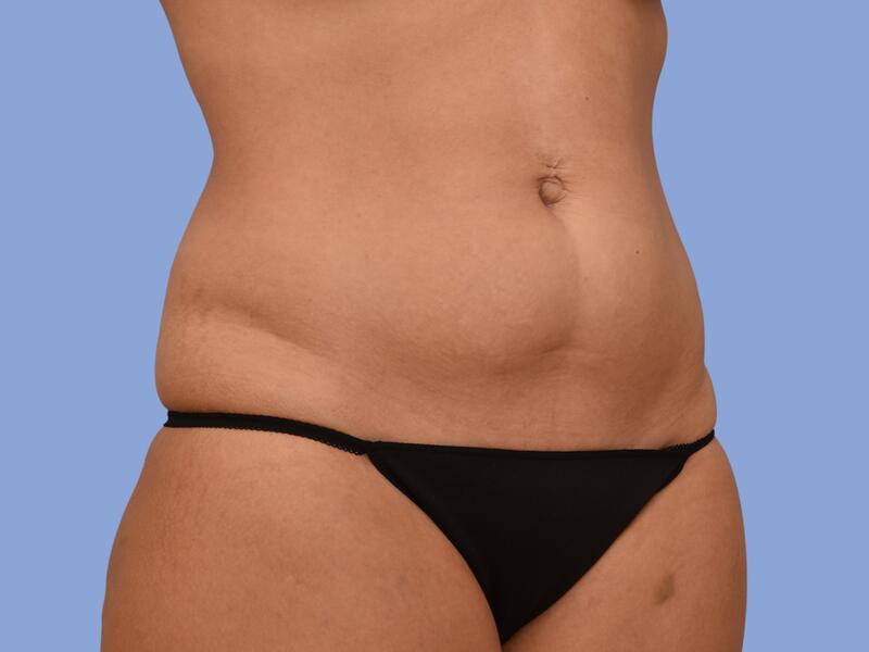 Abdominoplasty before & after photo