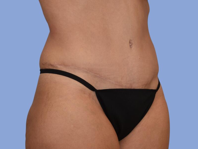 Abdominoplasty before & after photo