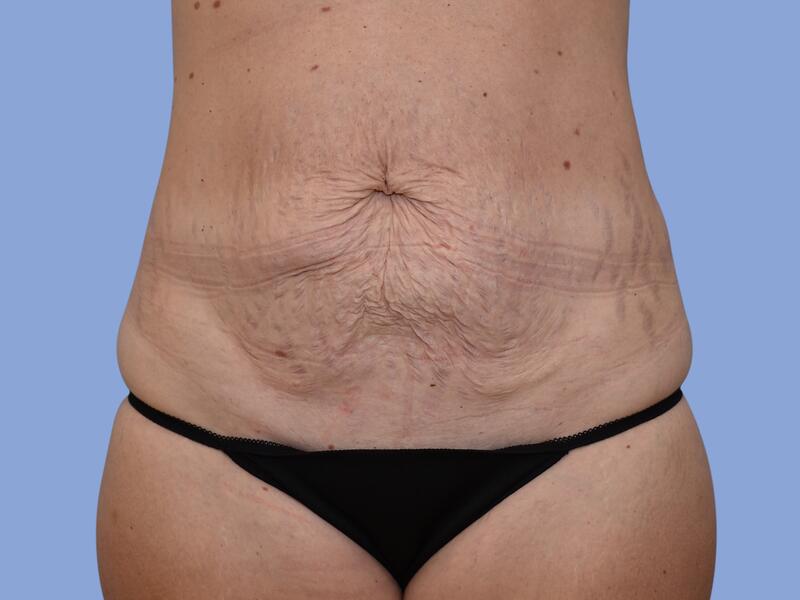 Abdominoplasty before & after photo