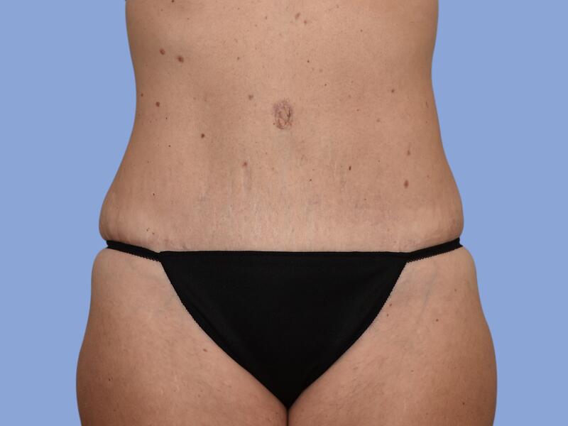 Abdominoplasty before & after photo