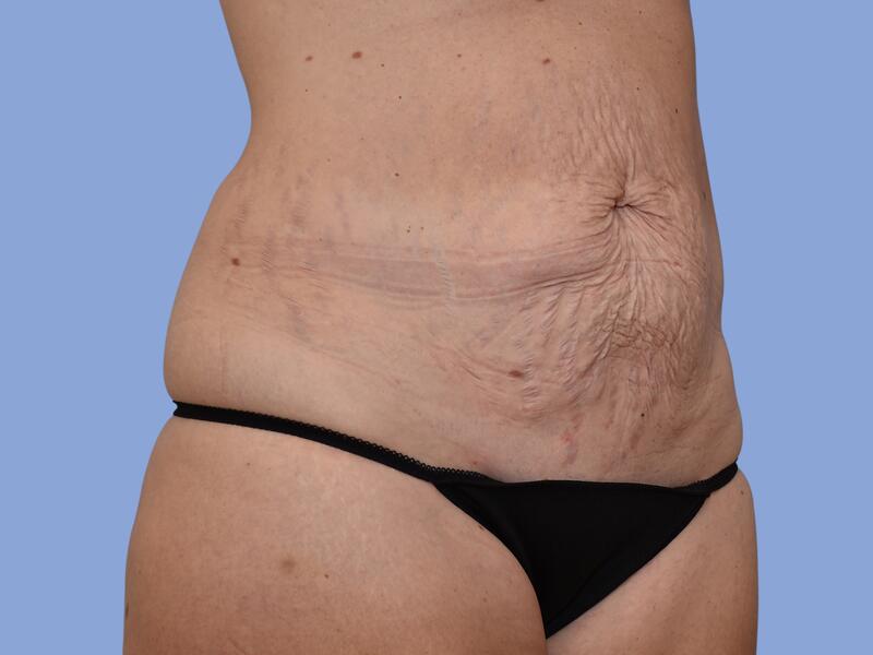 Abdominoplasty before & after photo