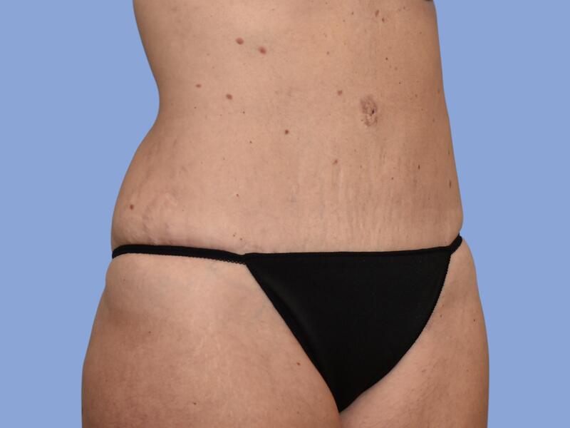 Abdominoplasty before & after photo