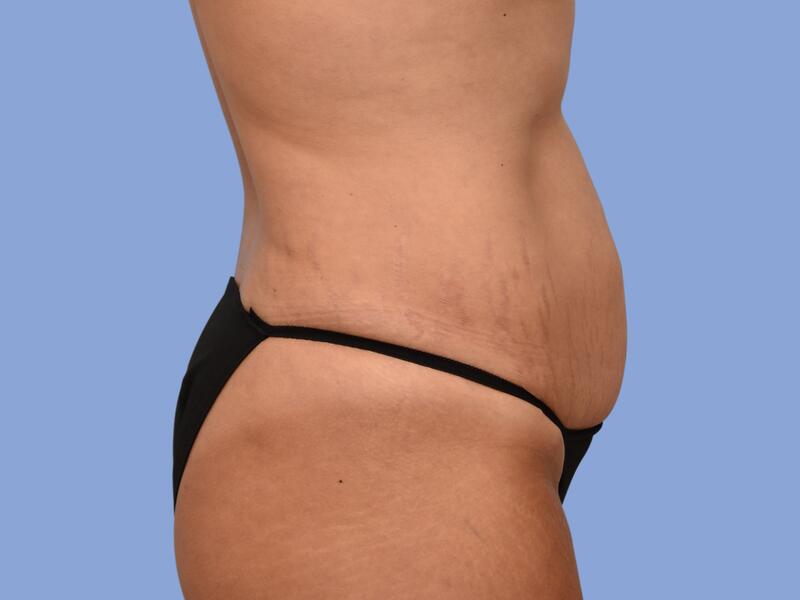 Abdominoplasty before & after photo