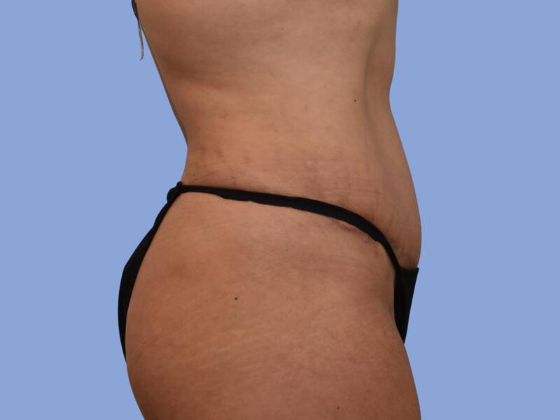 Abdominoplasty before & after photo