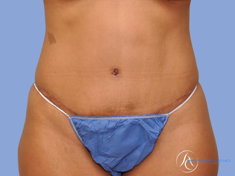 Abdominoplasty before & after photo