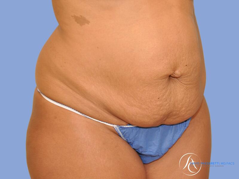 Abdominoplasty before & after photo