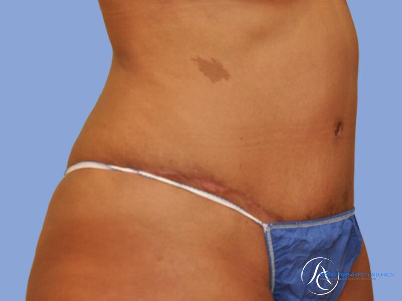 Abdominoplasty before & after photo