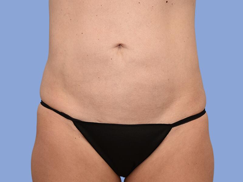 Abdominoplasty before & after photo