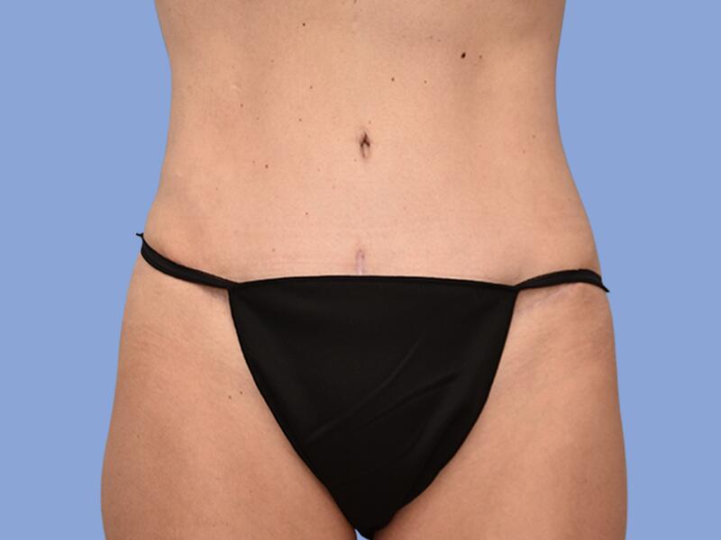 Abdominoplasty before & after photo