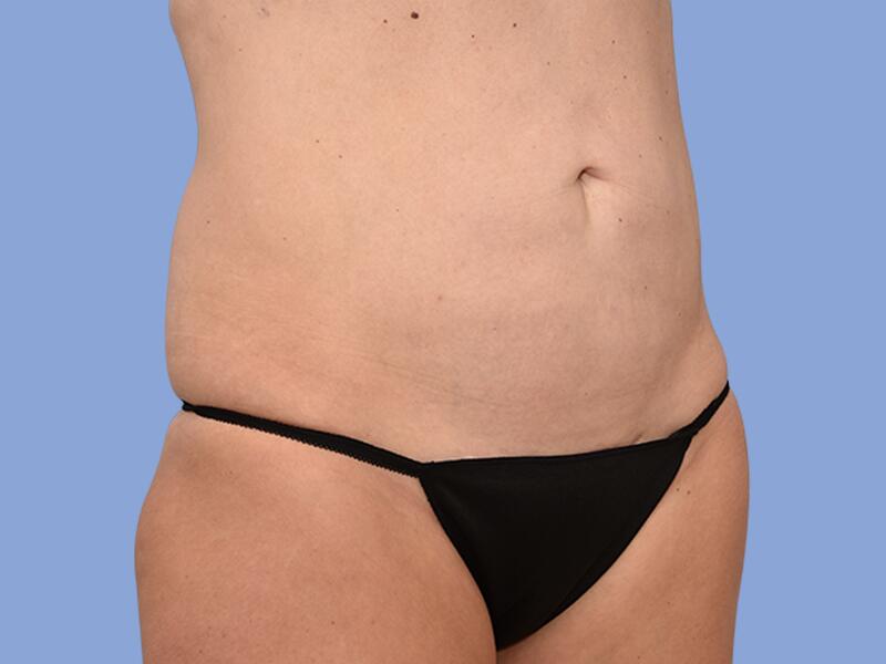 Abdominoplasty before & after photo