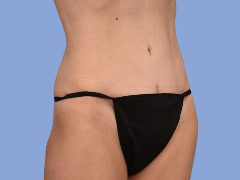 Abdominoplasty before & after photo