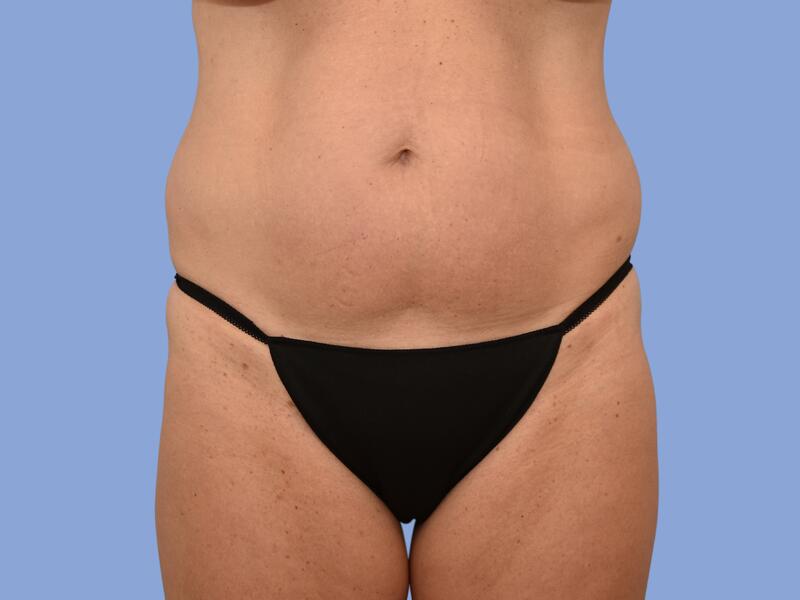 Abdominoplasty before & after photo