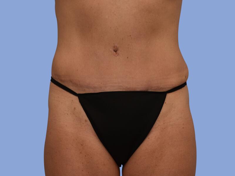 Abdominoplasty before & after photo