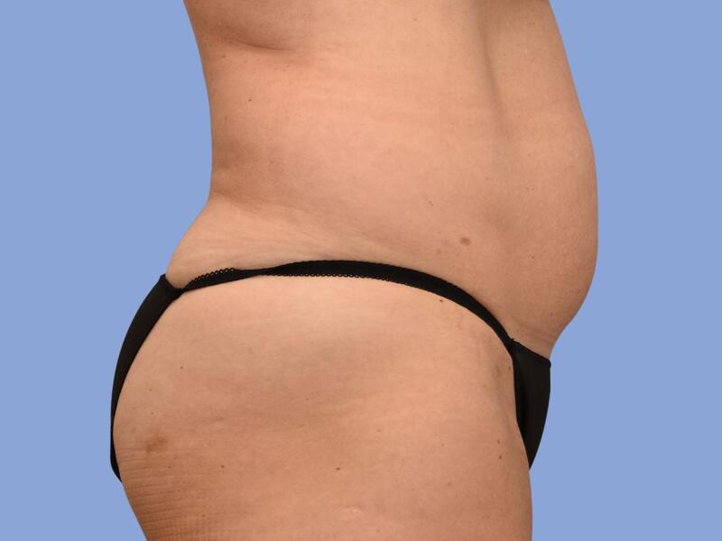 Abdominoplasty before & after photo