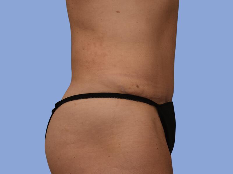 Abdominoplasty before & after photo