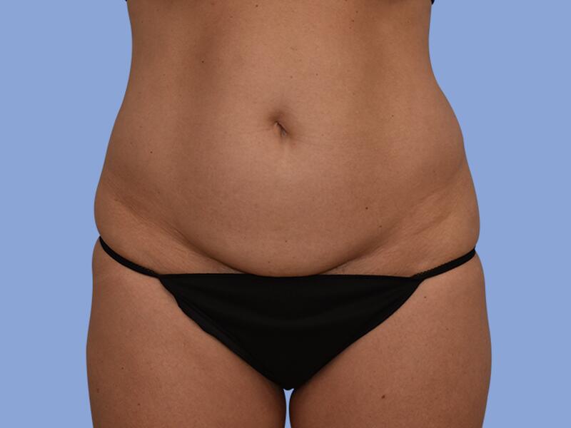 Abdominoplasty before & after photo