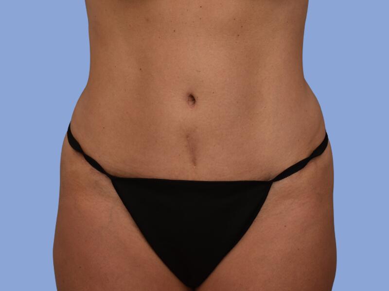 Abdominoplasty before & after photo