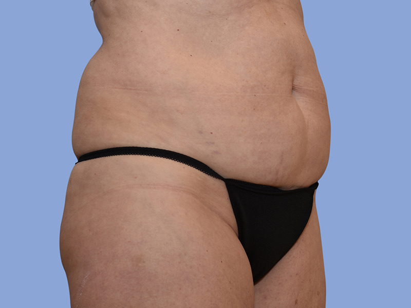 Abdominoplasty before & after photo