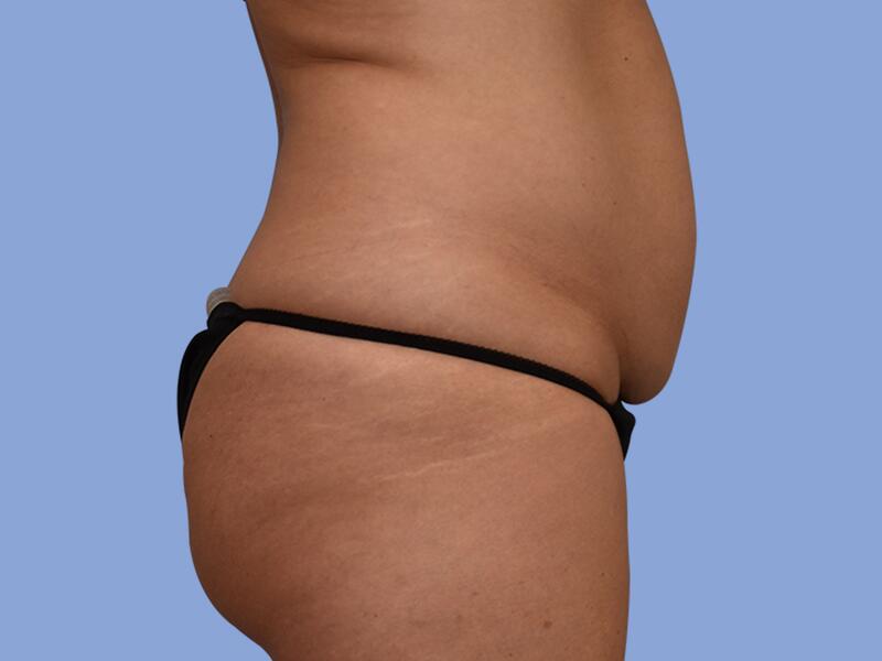 Abdominoplasty before & after photo