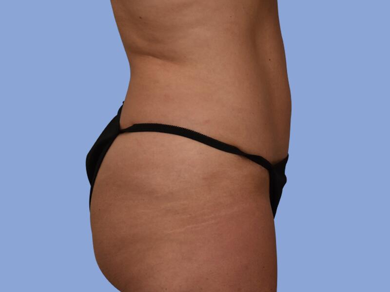 Abdominoplasty before & after photo