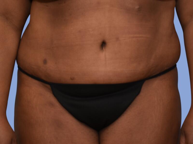 Abdominoplasty before & after photo