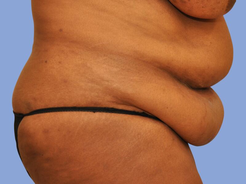 Abdominoplasty before & after photo