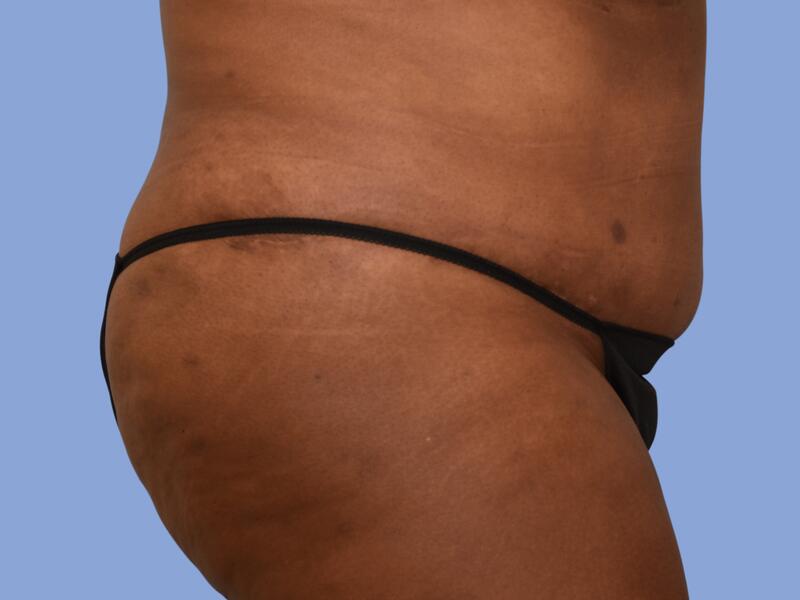 Abdominoplasty before & after photo