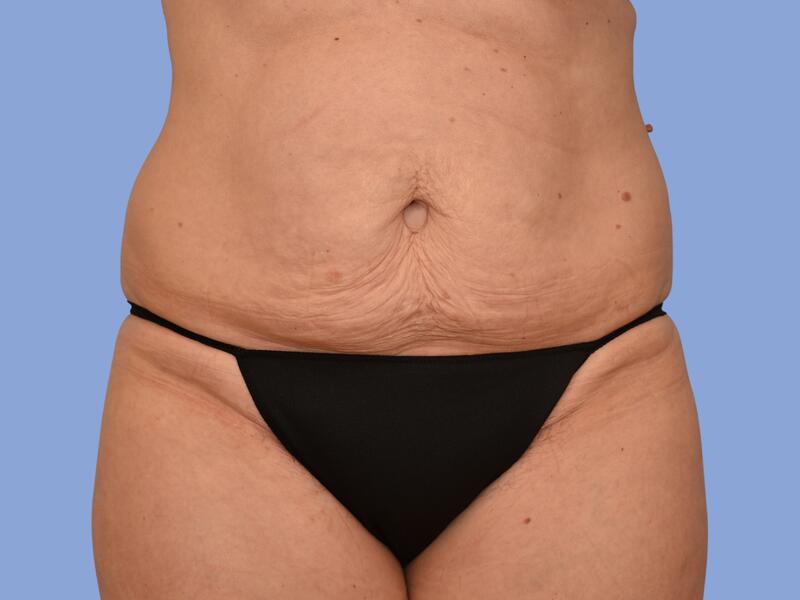 Abdominoplasty before & after photo