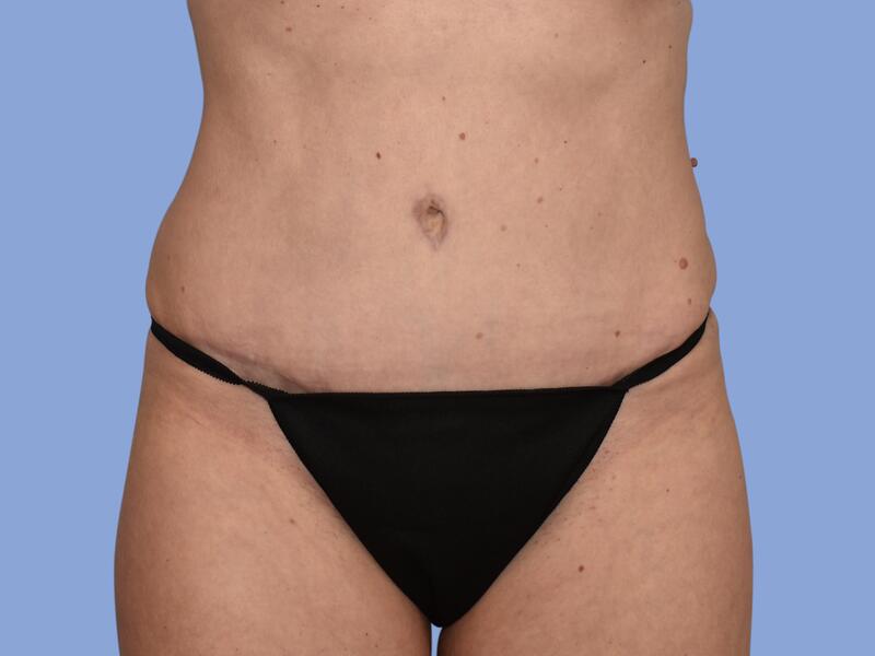 Abdominoplasty before & after photo