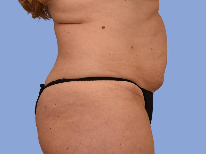 Abdominoplasty before & after photo