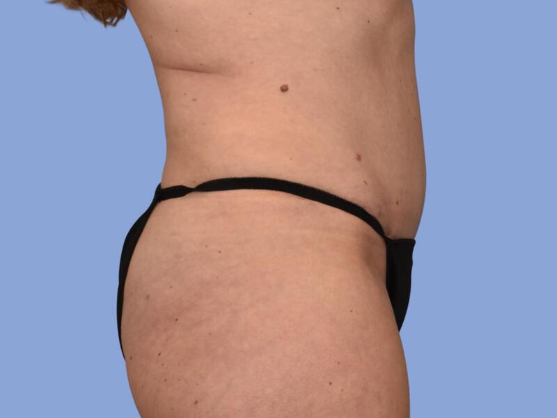 Abdominoplasty before & after photo